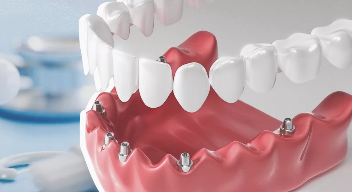 all-on-4 dental implants cost with insurance